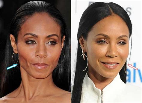 Jada Pinkett Smith Plastic Surgery Facelift Botox Nose Job