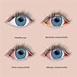 Pink Eye - Azar Eye Clinic