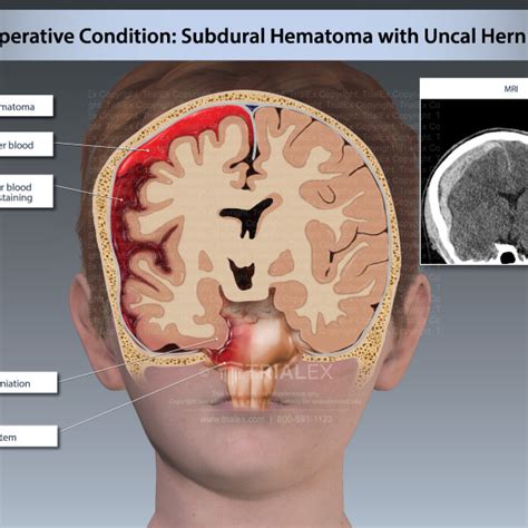 Pre Operative Condition Subdural Hematoma With Uncal Herniation