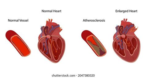 Normal Enlarged Heart Cardiomegaly Atherosclerosis Direction Stock