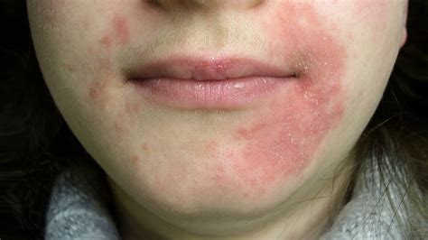 What Is Perioral Dermatitis Symptoms Causes Diagnosis Treatment