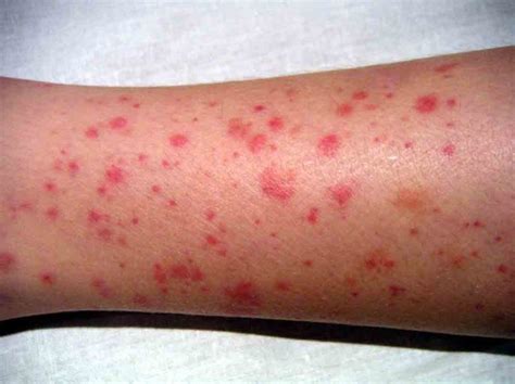 When To Worry About A Rash In Adults Page 13 Of 15 Healthella