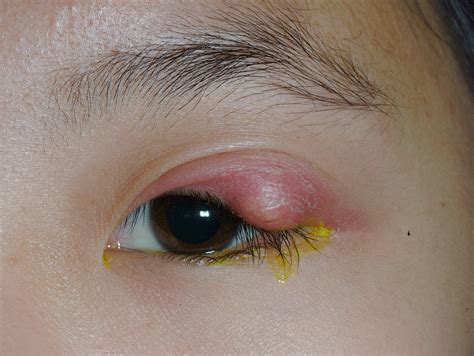 Stye Eyewiki