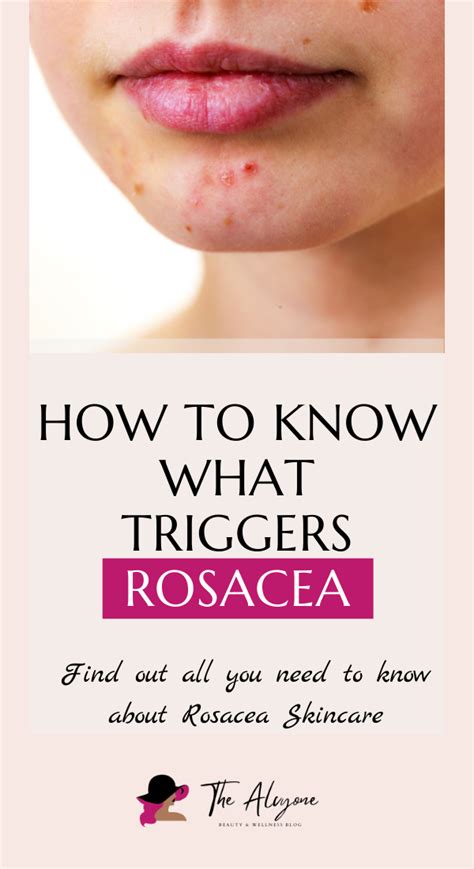 Rosacea Causes Triggers And Skincare Routine For Rosacea Artofit