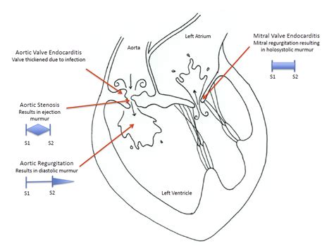 Bacterial Endocarditis Cardiorush