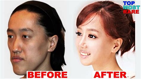 chinese plastic surgery before after famousfaceshub