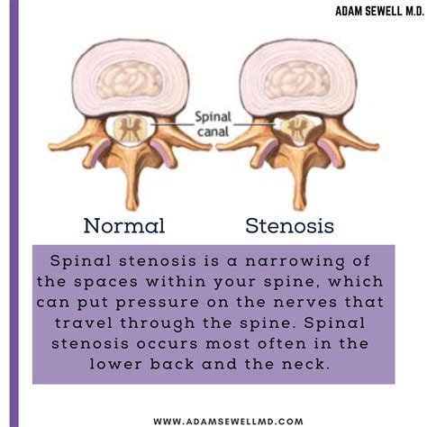 Spinal Stenosis Is A Narrowing Of The Spaces Within Your Spine Which