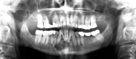Odontogenic Keratocyst Dr Gs Toothpix