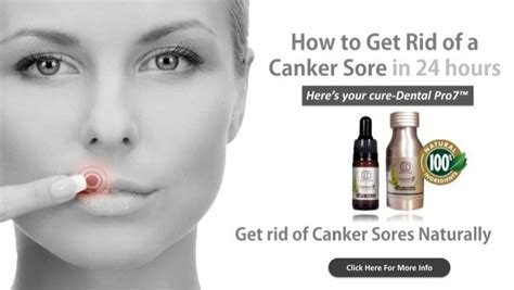 How To Get Rid Of A Canker Sore In 24 Hours