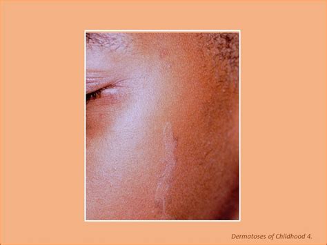 Dermatoses Of Childhood 7 Photoclinic Cases