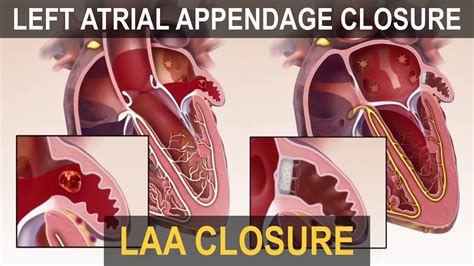 Left Atrial Appendage Laa Occlusion Youtube