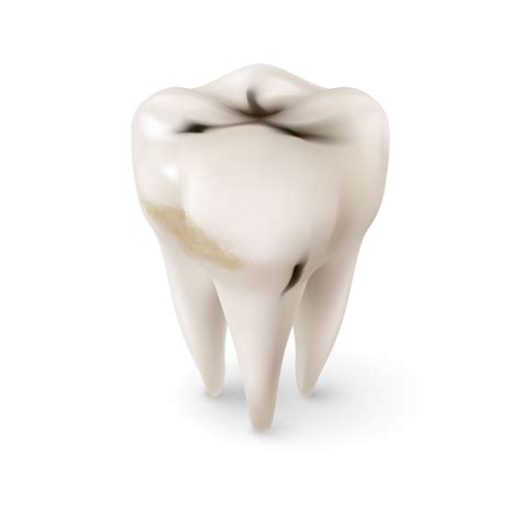 Infected Wisdom Tooth Treatment Emergency Dentist London