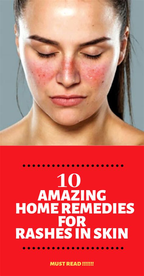 10 Amazing Home Remedies For Rashes Heat Rash Also Known As Prickly