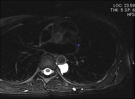 Chest Mri T2 Weighted Image Showing A Homogenous Tumor With A