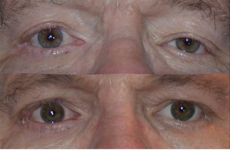 Denver Eyelid Surgery Blepharoplasty Denver Eyebag Treatment