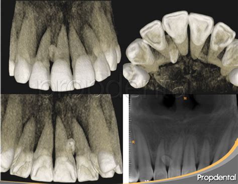 ¿qué Son Los Dientes Supernumerarios Causas Y Tratamiento