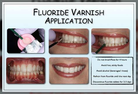 Fluoride Varnish Types Advantages And Safety Dentist Ahmed