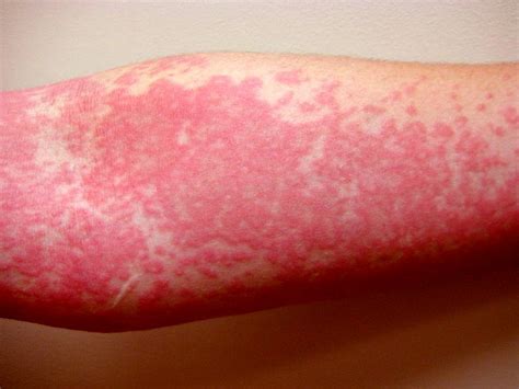 Types Of Urticaria Hives Types Of Physical Urticaria The Dynamic