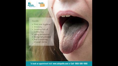 What Is Black Hairy Tongue How Can It Be Prevented And Managed
