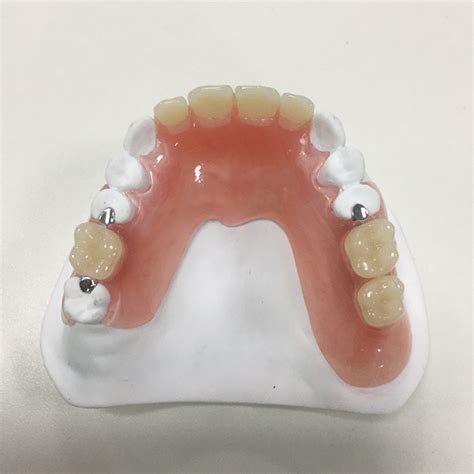 Difference Between Cast Partial Denture And Removable Partial Denture