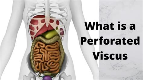 What Is A Perforated Viscus Youtube
