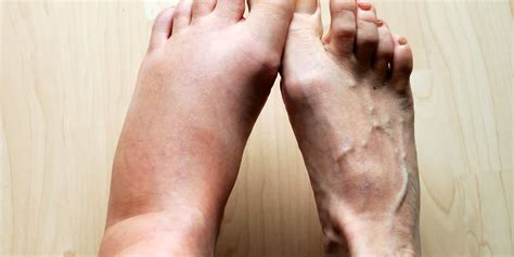 The Odd Reason Why You Have Swollen Feet
