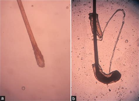 Telogen Effluvium Indian Journal Of Dermatology Venereology And