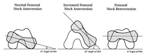 Femoral Anteversion 2 Foot Doctor San Diego La Jolla Podiatrist