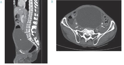 Figure 1 From An Unusual Case Of Bilateral Peripheral Edema In A Male