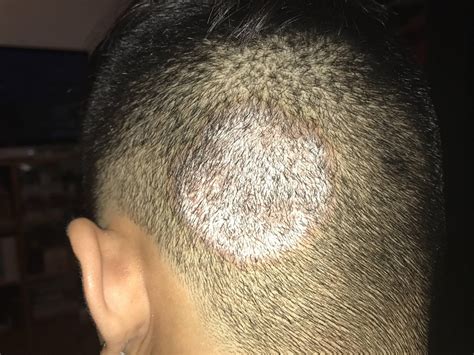 fungal infection on scalp ringworm psoriasis x post r dermatology medical