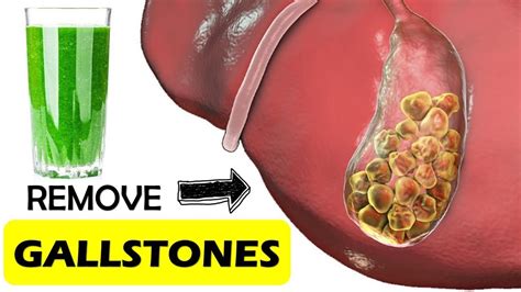 This Can Flush Hundreds Of Gallstones Naturally How To Dissolve