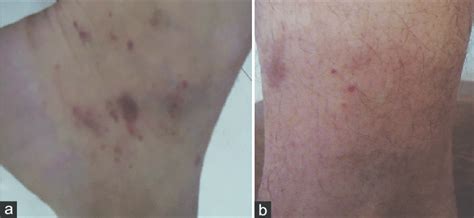 A Brownish Macules And Patches Of Pigmented Purpuric Dermatosis Near