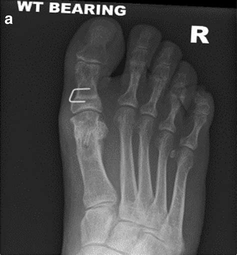 A And B Post Operative Ap And Lateral Radiographs Taken At 12 Months