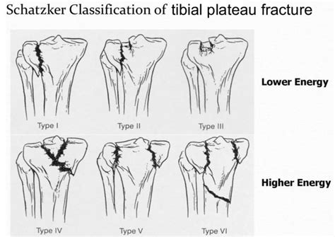 Tibial Plateau Fracture Causes Types Symptoms Diagnosis And Treatment