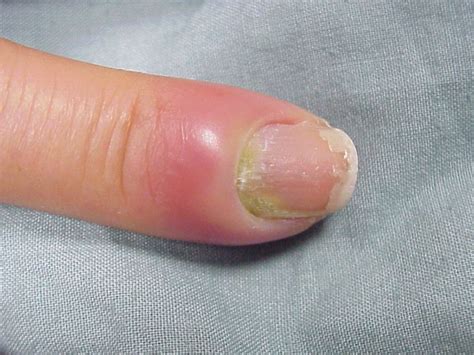 Paronychia is the most common nail infection. Paronychia (omloop, ontsteking van de nagel wal)