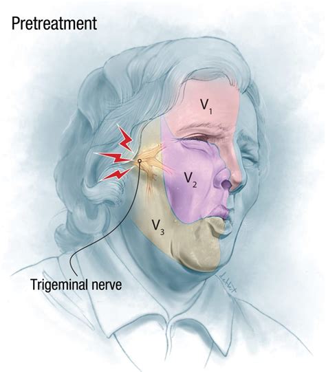 Microvascular Decompression Of Trigeminal Neuralgia In A Patient With