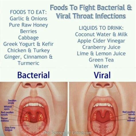 Differences Between Bacterial Vs Viral Sore Throat Infection Symptoms