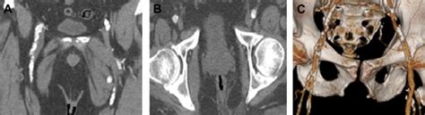 Femoral Artery Calcification As A Determinant Of Success For