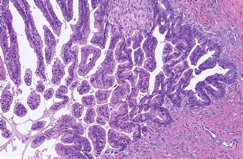 Pathology Outlines Mucinous Borderline Tumor