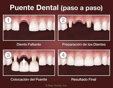 Coronas Y Puentes Dentist Lowell Ma Dental Education Library