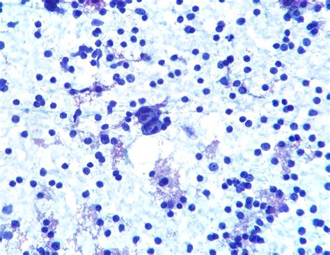 Symptoms may include fever, night sweats, and weight loss. Hodgkin Lymphoma: Reed-Sternberg Cell on FNA | Ed Uthman ...