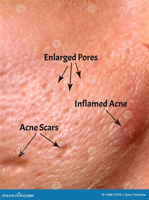 Skin With Acne Acne Scars Enlarged Pores Stock Photo Image Of
