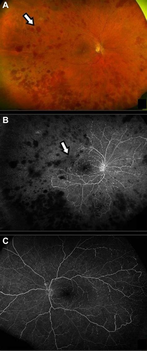 Miliary Tuberculosis Developing During Adalimumab Treatment For Behçet