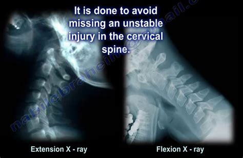 Cervical Spine Instability Flexion Extension X Rays By Nabil
