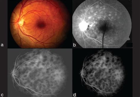 Multiple Evanescent White Dot Syndrome Mewds Download Scientific