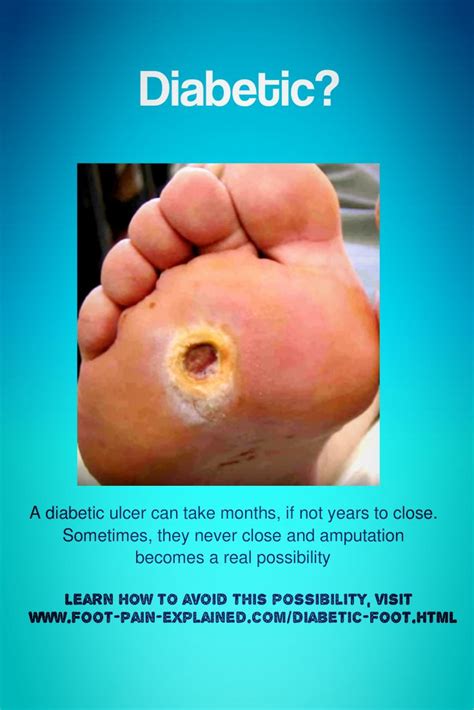 Pin On The Diabetic Foot