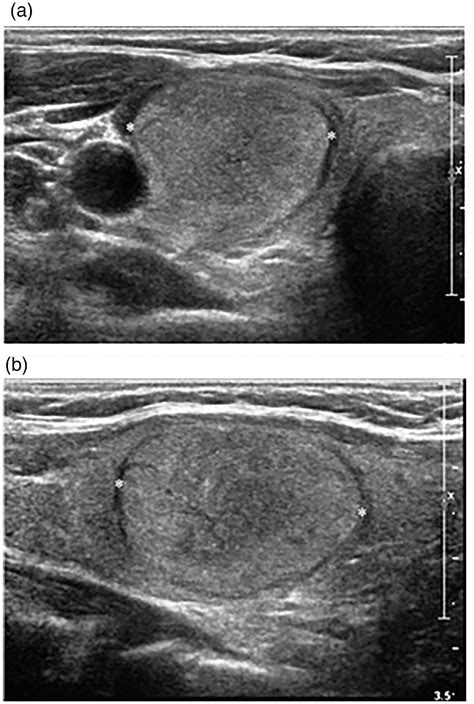 Radiofrequency Ablation Of Solid Non Functional Thyroid Nodules