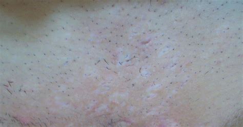 Laser Hair Removal With Hidradenitis Suppurativa October 6th