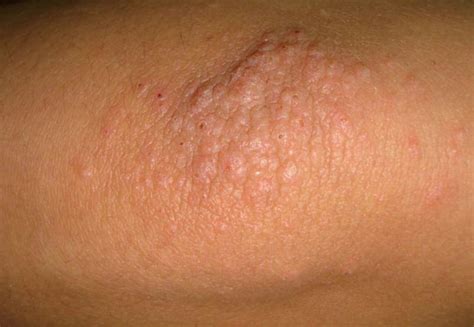 Itchy Elbows Causes Bumps Rash No Rash Non Itchy Symptoms Treat Hot