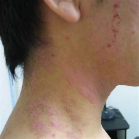 Image Gallery Atopic Dermatitis In Adults
